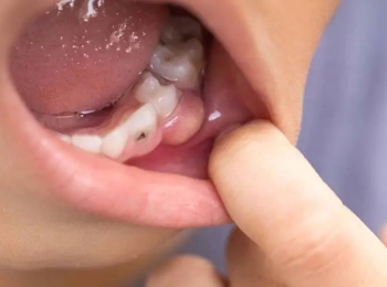 كيفية علاج خراج الأسنان للاطفال في المنزل