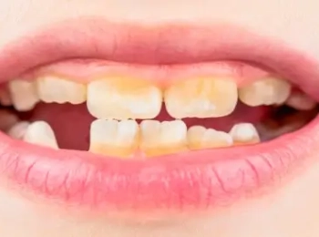 أفضل علاج تصبغ الأسنان عند الأطفال بالمدينة المنورة