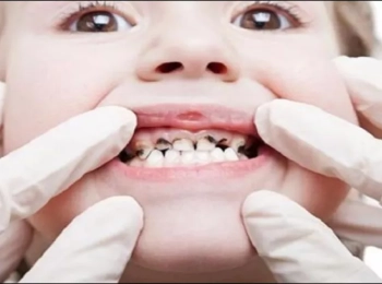 كيفية علاج اسنان مسوسة للأطفال بالكامل مع د.رامي نفاخ