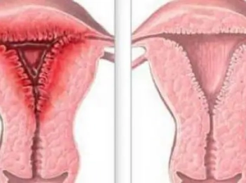 كيف اعرف ان عندي التهاب في المهبل مع د.أُنس الشريف؟