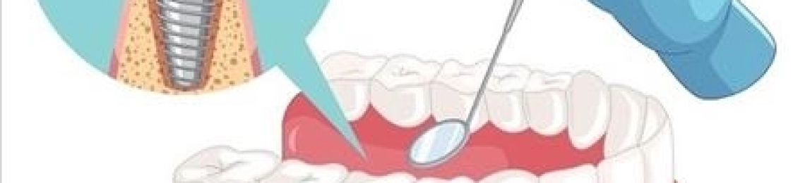 كيف اعرف نجاح زراعة الأسنان بعد العملية؟