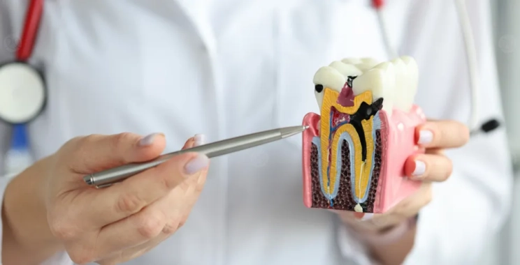 ماذا افعل بعد حشو العصب؟ نصائح لتجنب المضاعفات