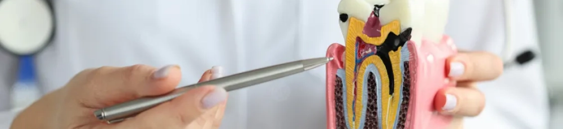 ماذا افعل بعد حشو العصب؟ نصائح لتجنب المضاعفات