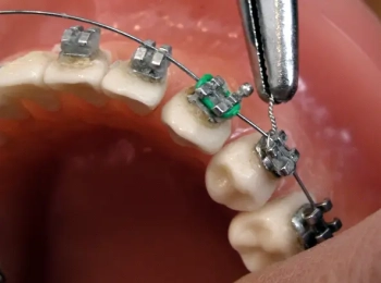 تقويم الأسنان braces للأطفال أفضل عمر وفوائد العلاج المبكر