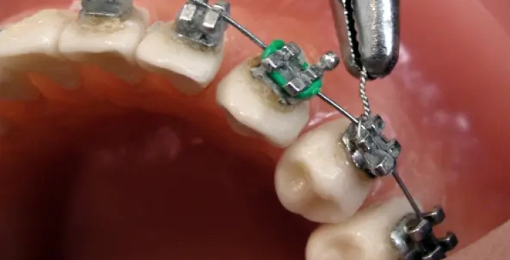 تقويم الأسنان braces للأطفال أفضل عمر وفوائد العلاج المبكر