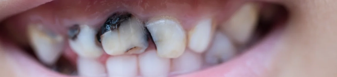 حشو الأسنان الأمامية المسوسة: أنواع الحشوات الأنسب وأهم النصائح