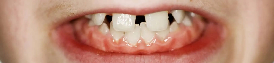 شكل الأسنان التي تحتاج إلى تقويم: علامات تشير إلى أنك بحاجة لعلاج تقويمي