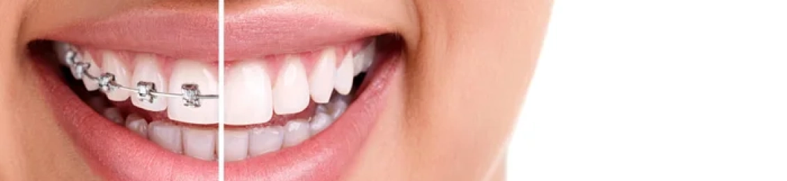 شكل الأسنان الطبيعي بعد التقويم: كيف تبدو ابتسامتك بعد انتهاء العلاج؟