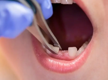 ما هي افضل النصائح والدواعي عند خلع الأسنان اللبنية المسوسة