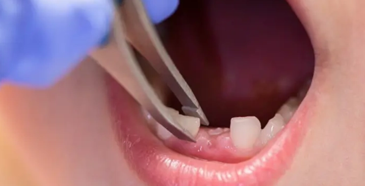 ما هي افضل النصائح والدواعي عند خلع الأسنان اللبنية المسوسة