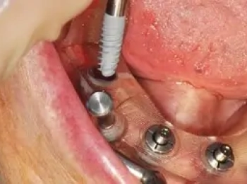 مراحل زراعة الأسنان بدون جراحة مع د.محمد بشار