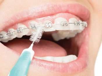 هل يمكن أن يحدث سقوط الأسنان بسبب التقويم؟ الأسباب الحقيقية ونصائح الوقاية