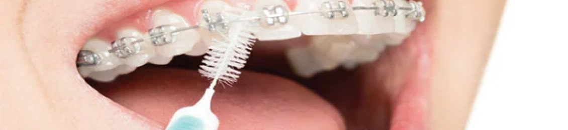 هل يمكن أن يحدث سقوط الأسنان بسبب التقويم؟ الأسباب الحقيقية ونصائح الوقاية