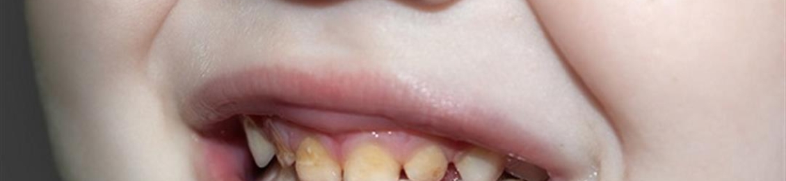ما هو علاج تسوس الأسنان عند الأطفال 5 سنوات