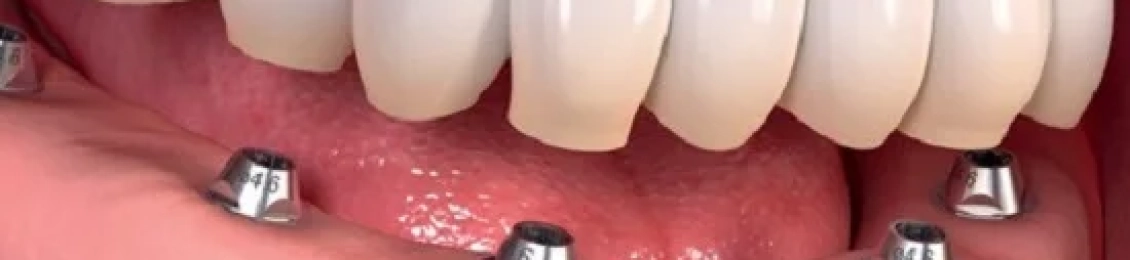 فوائد وتحديات زراعة الأسنان في الفك السفلي