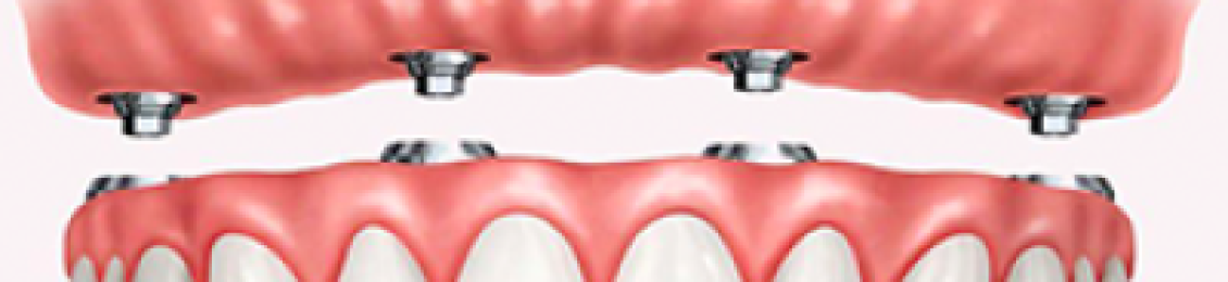 أفضل دكتور زراعة أسنان في الفك العلوي في المدينة المنورة