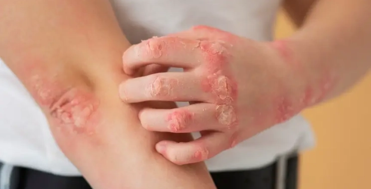 أنواع الأكزيما بالصور وعلاجها للاطفال الأعراض والوقاية