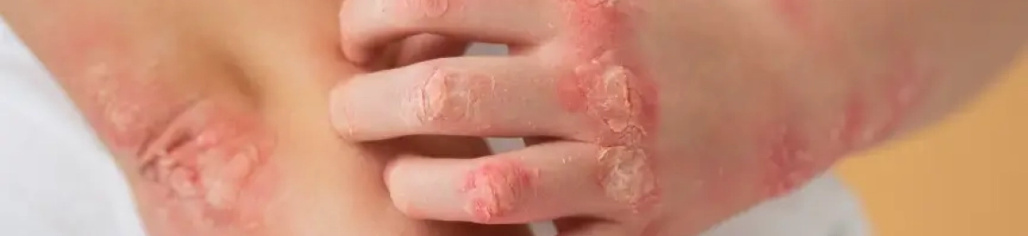 أنواع الأكزيما بالصور وعلاجها للاطفال الأعراض والوقاية