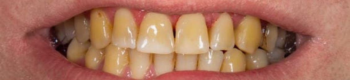 أسباب اصفرار الاسنان وعلاجه في مجمع الطب المتميز