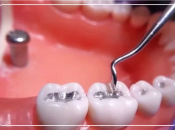 4 انواع حشوة الاسنان والفرق بينهما مع مجمع الطب المتميز