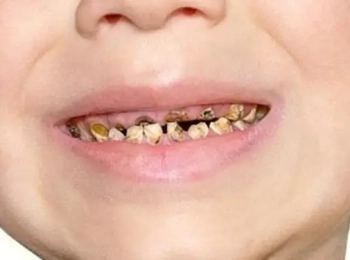 اسباب تاكل الاسنان وعلاجه مع اطباء مجمع الطب المتميز
