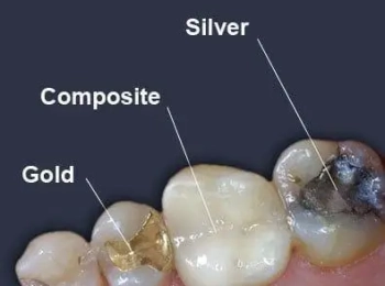 أفضل انواع حشوات الاسنان المتقدمة في المدينة المنورة