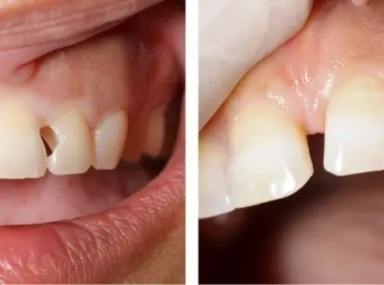 اهم انواع حشوة الاسنان الامامية وكيفية تركيبها في المدينة المنورة