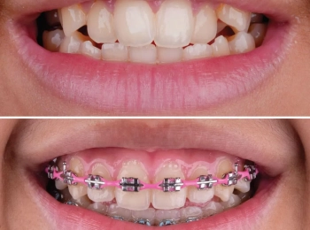 انواع الاسنان التي تحتاج إلى تقويم وطرق علاجها