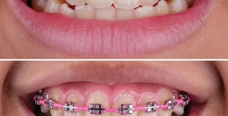 انواع الاسنان التي تحتاج إلى تقويم وطرق علاجها