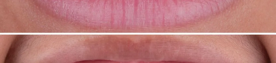 انواع الاسنان التي تحتاج إلى تقويم وطرق علاجها