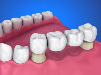 انواع تركيبات الاسنان الثابتة وفوائدها