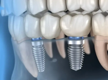ما هي زراعة الاسنان الفورية وكيف تتم؟