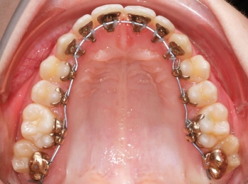 تعرف على شكل الأسنان التي تحتاج إلى تقويم في مجمع الطب المتميز بالمدينة المنورة