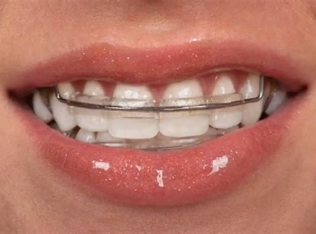 مثبت الاسنان بعد التقويم وأهميته وانواعه