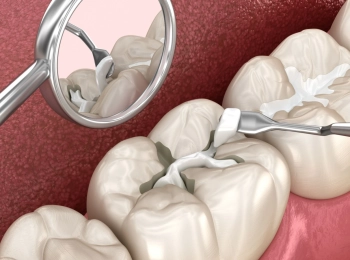 الم الاسنان بعد الحشو ونصائح لتخفيف الألم مع د.إبراهيم زيتوني