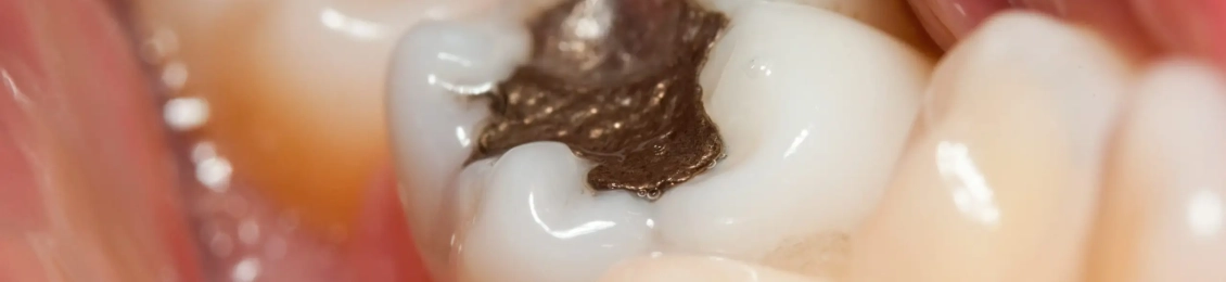 كيف تتخلص من الم الاسنان بعد سحب العصب مع د.طارق ابو حماد