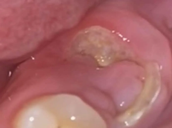 هل يزول الخراج بعد سحب العصب؟