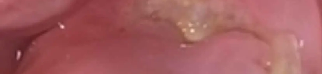 هل يزول الخراج بعد سحب العصب؟