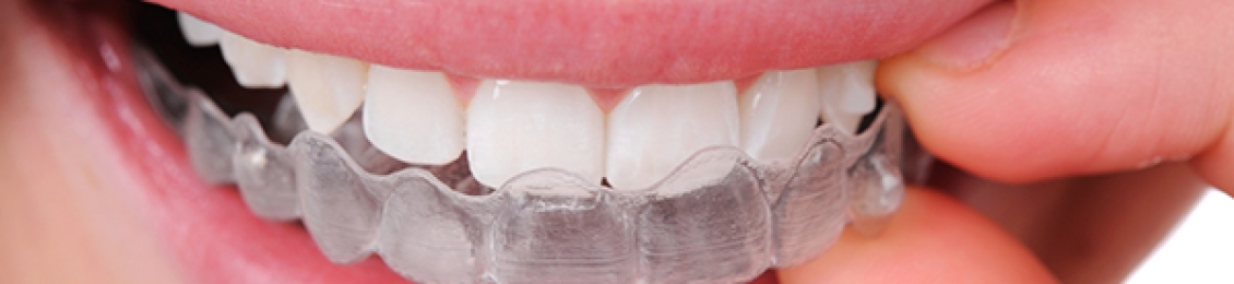 ما هو تقويم الأسنان الشفاف وكيفية تركيبه في مجمع الطب المتميز   