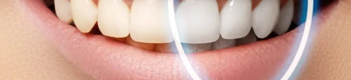 تبييض الاسنان في المدينة المنورة المزايا والشروط