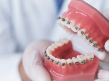 افضل انواع تقويم الاسنان في المدينه المنوره