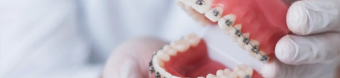 افضل انواع تقويم الاسنان في المدينه المنوره