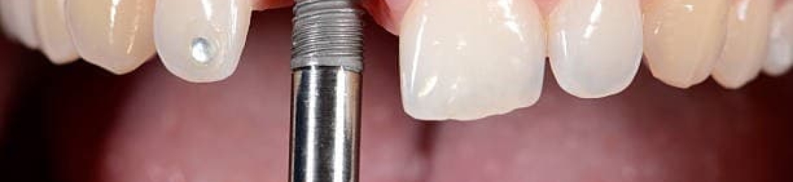 زراعة الاسنان لكبار السن: هل هي آمنة وناجحة