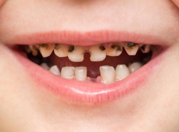 أهم اسباب تسوس الاسنان للاطفال عند عمر السنة