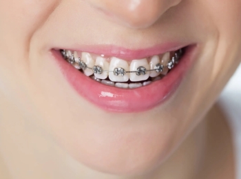 تعرف على مدة تقويم الأسنان للحالات البسيطة في مجمع الطب المتميز بالمدينة المنورة
