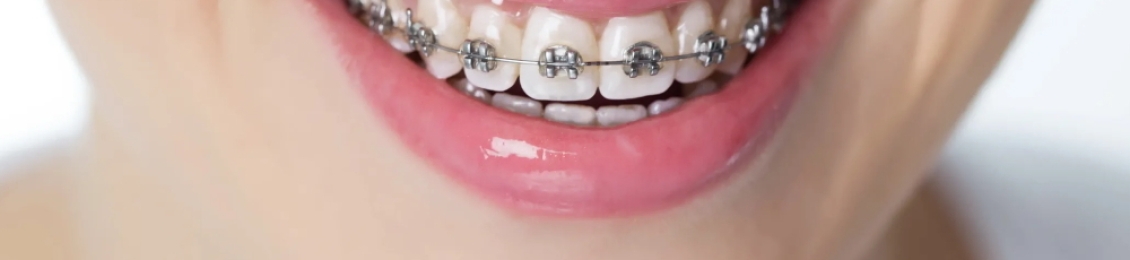 تعرف على مدة تقويم الأسنان للحالات البسيطة في مجمع الطب المتميز بالمدينة المنورة