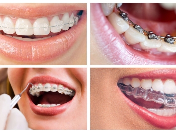 تقويم الاسنان لمدة 6 شهور ودواعي استخدامه