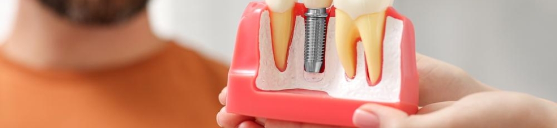 زراعة الاسنان لمريض السكر مع د.محمد بشار