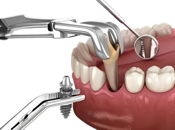 الخلع الجراحي للاسنان بأمان في مجمع الطب المتميز بالمدينة المنورة