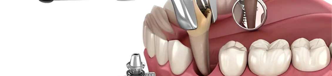 الخلع الجراحي للاسنان بأمان في مجمع الطب المتميز بالمدينة المنورة